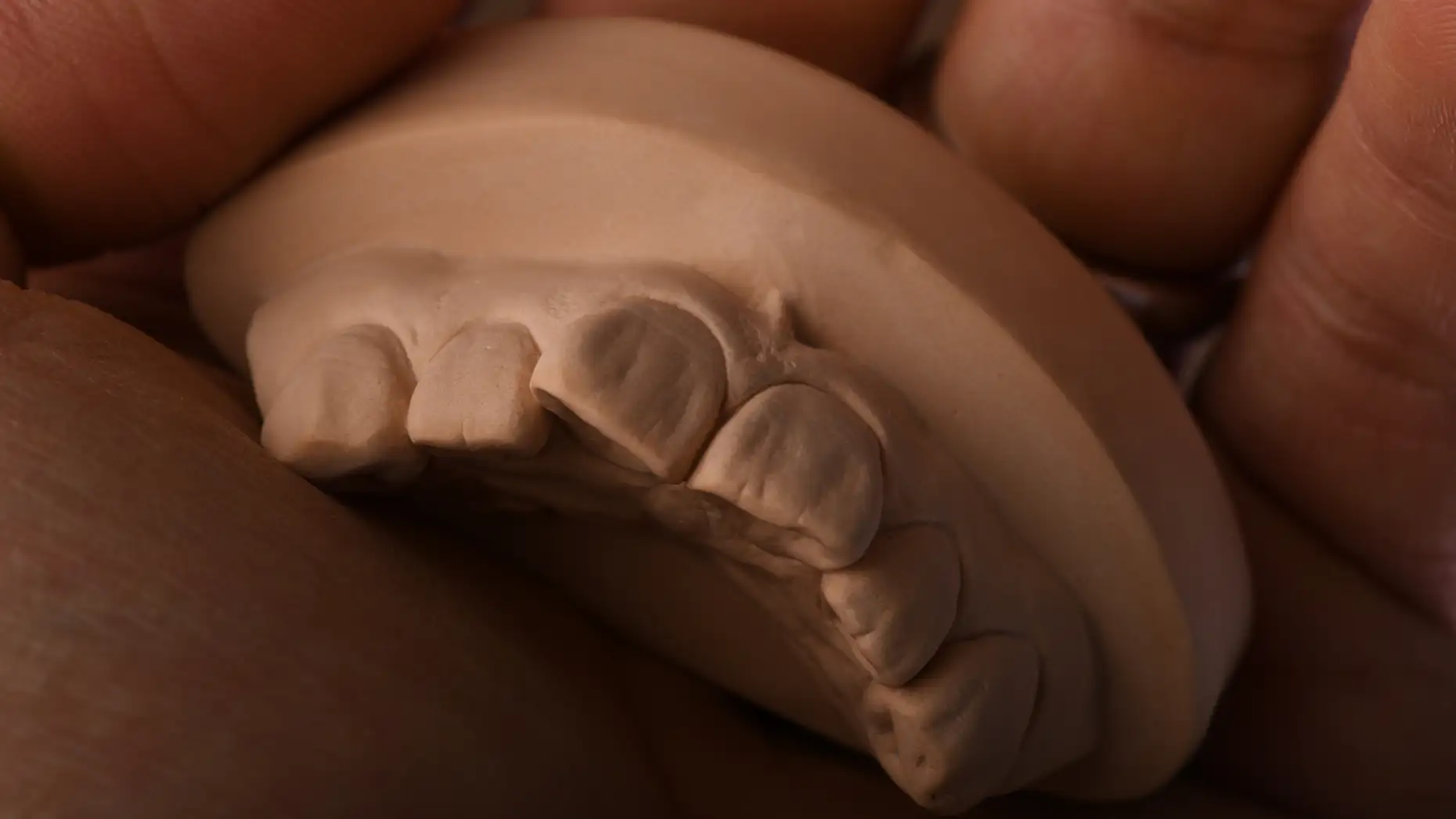 서울심도치과의원 | 앞니재치료 라미네이트