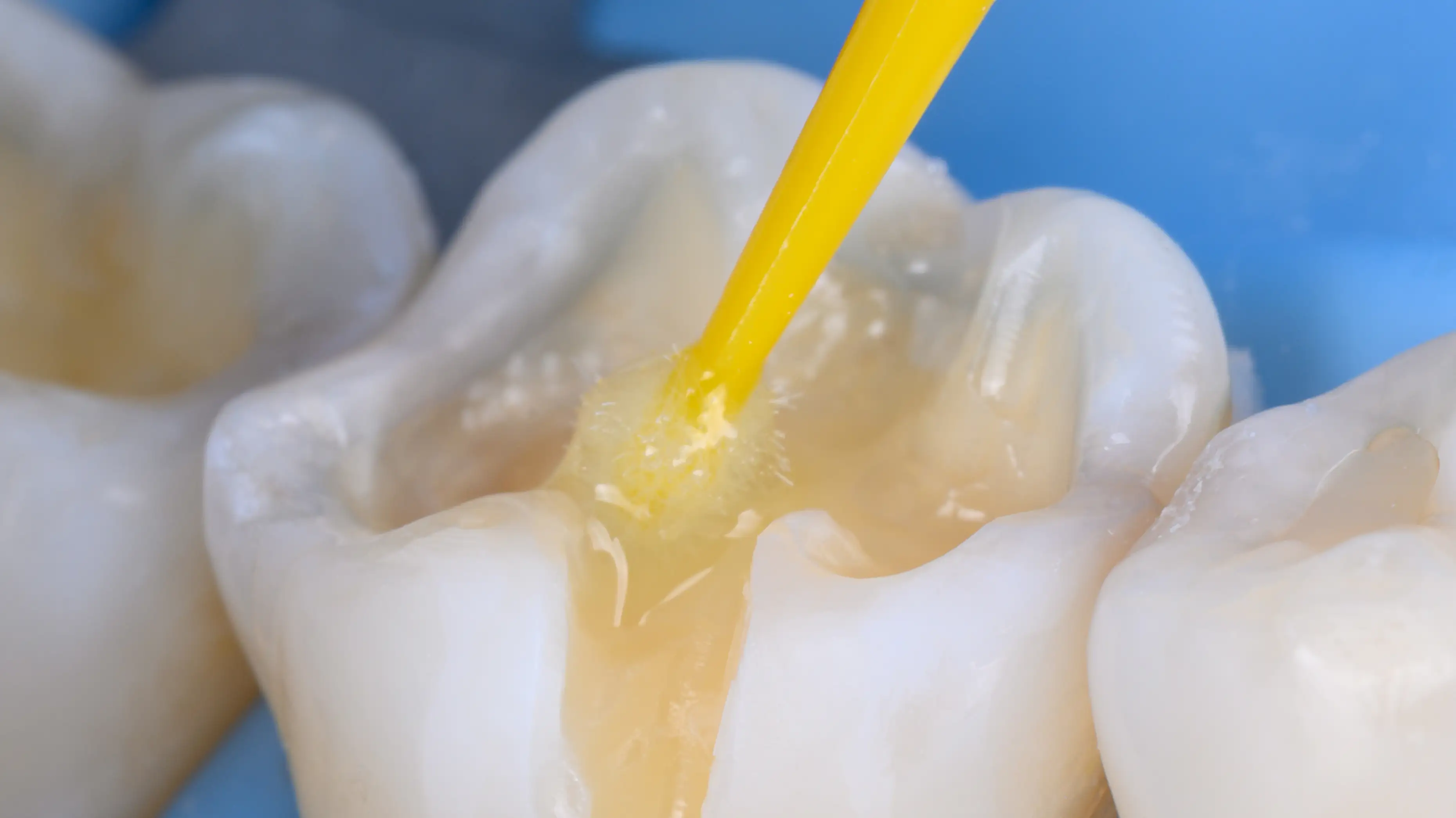 서울심도치과의원 | 충치치료 검사