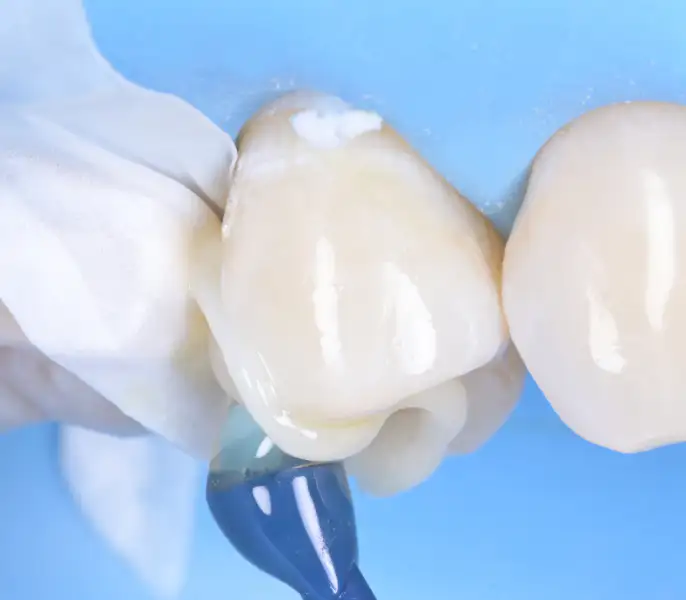 서울심도치과의원 충치치료