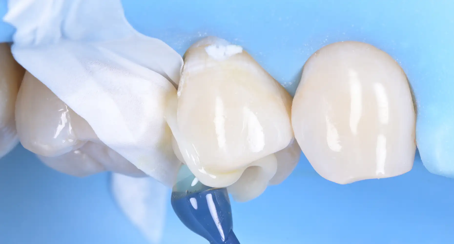 서울심도치과의원 충치치료