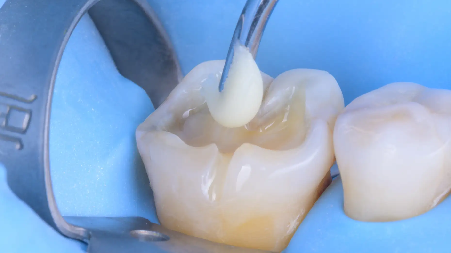 서울심도치과의원 | 충치치료 검사