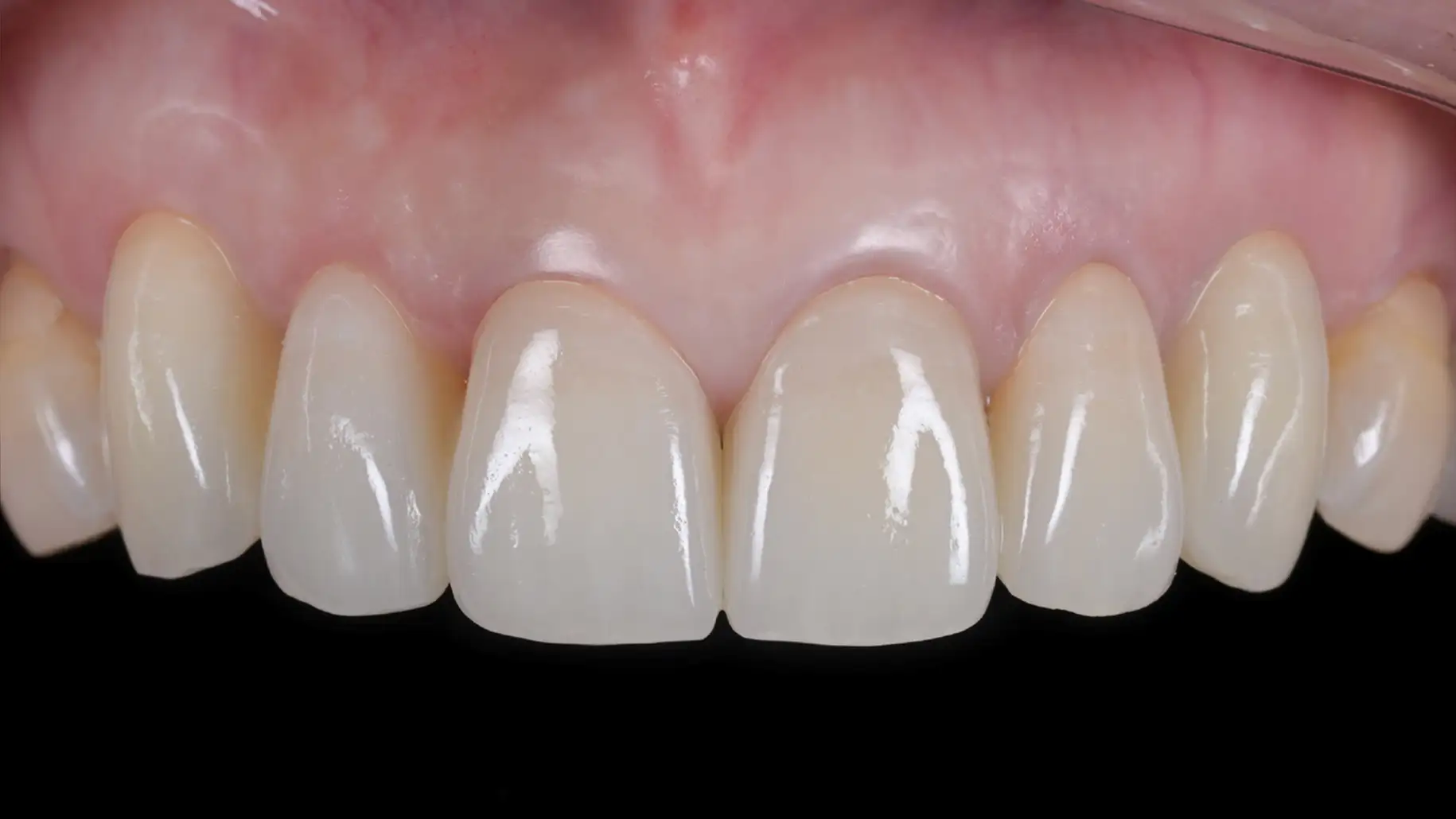 서울심도치과의원 앞니재치료 심미 보철 | 재치료를 통한 잇몸 라인 비대칭 교정 증례