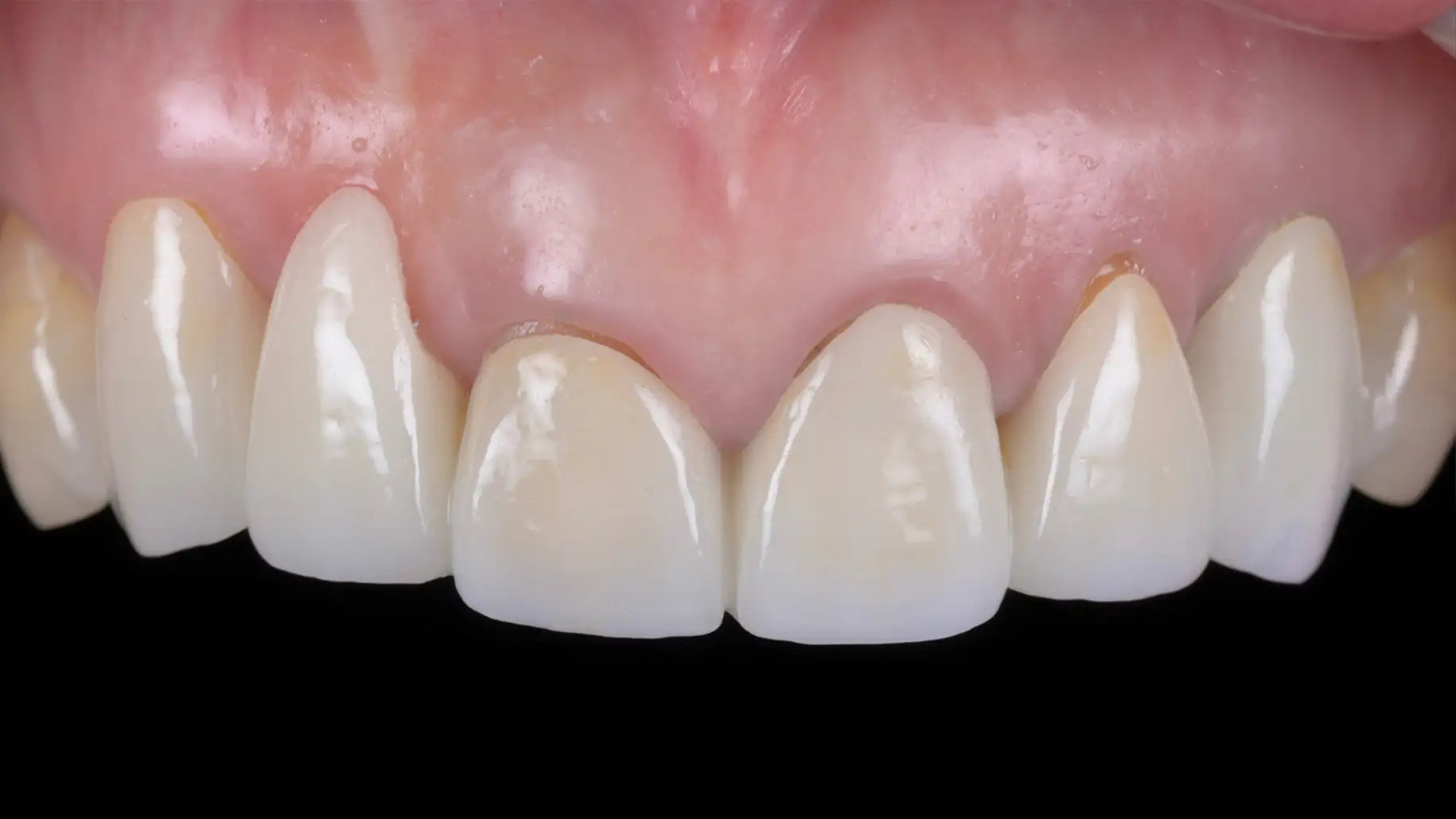 서울심도치과의원 앞니재치료 심미 보철 | 재치료를 통한 잇몸 라인 비대칭 교정 증례