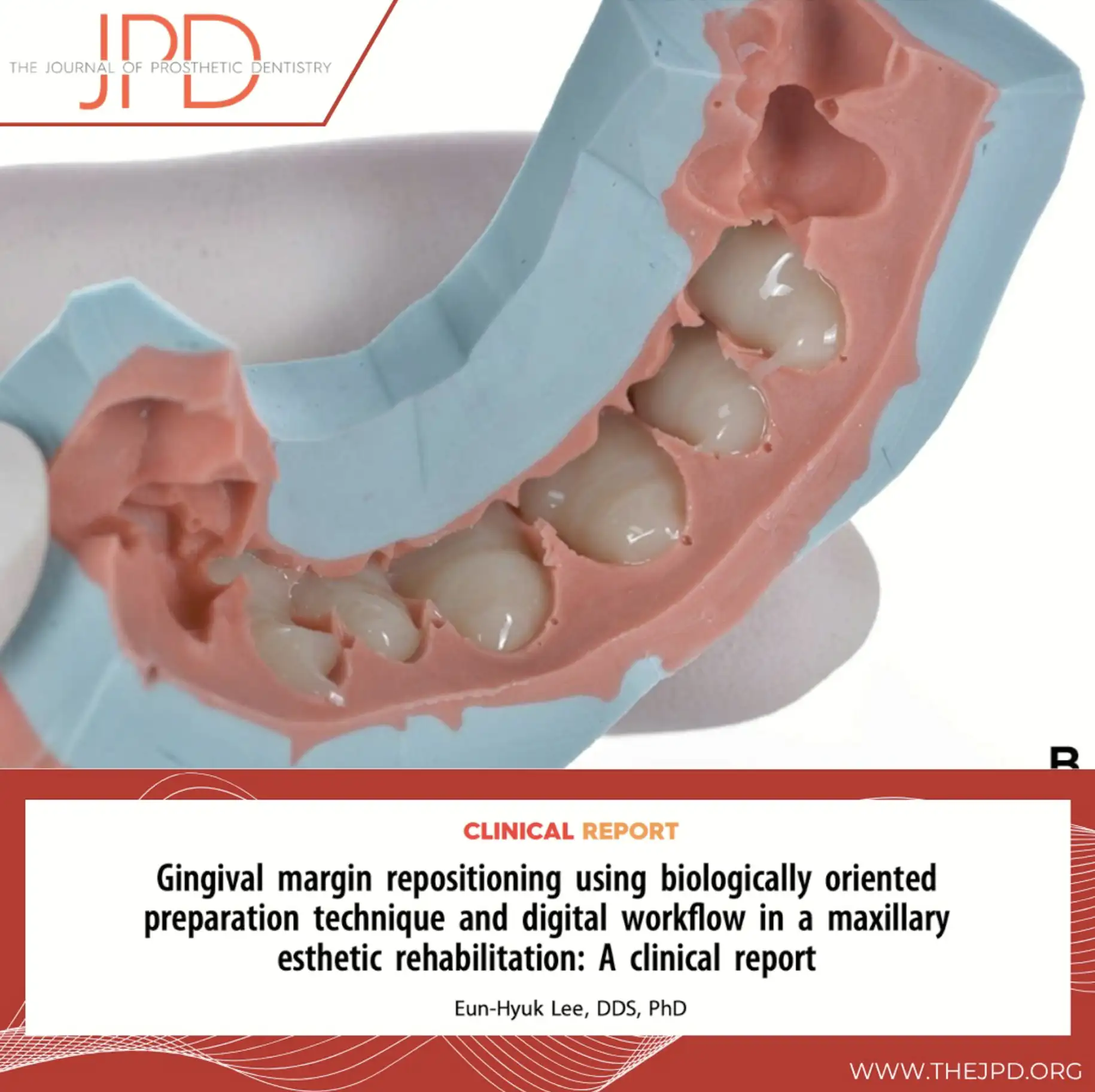 서울심도치과의원 앞니재치료 심미 보철 | 치과보철학 분야 SCIE급 국제 학술지, The Journal of Prosthetic Dentistry(JPD) 논문 게재