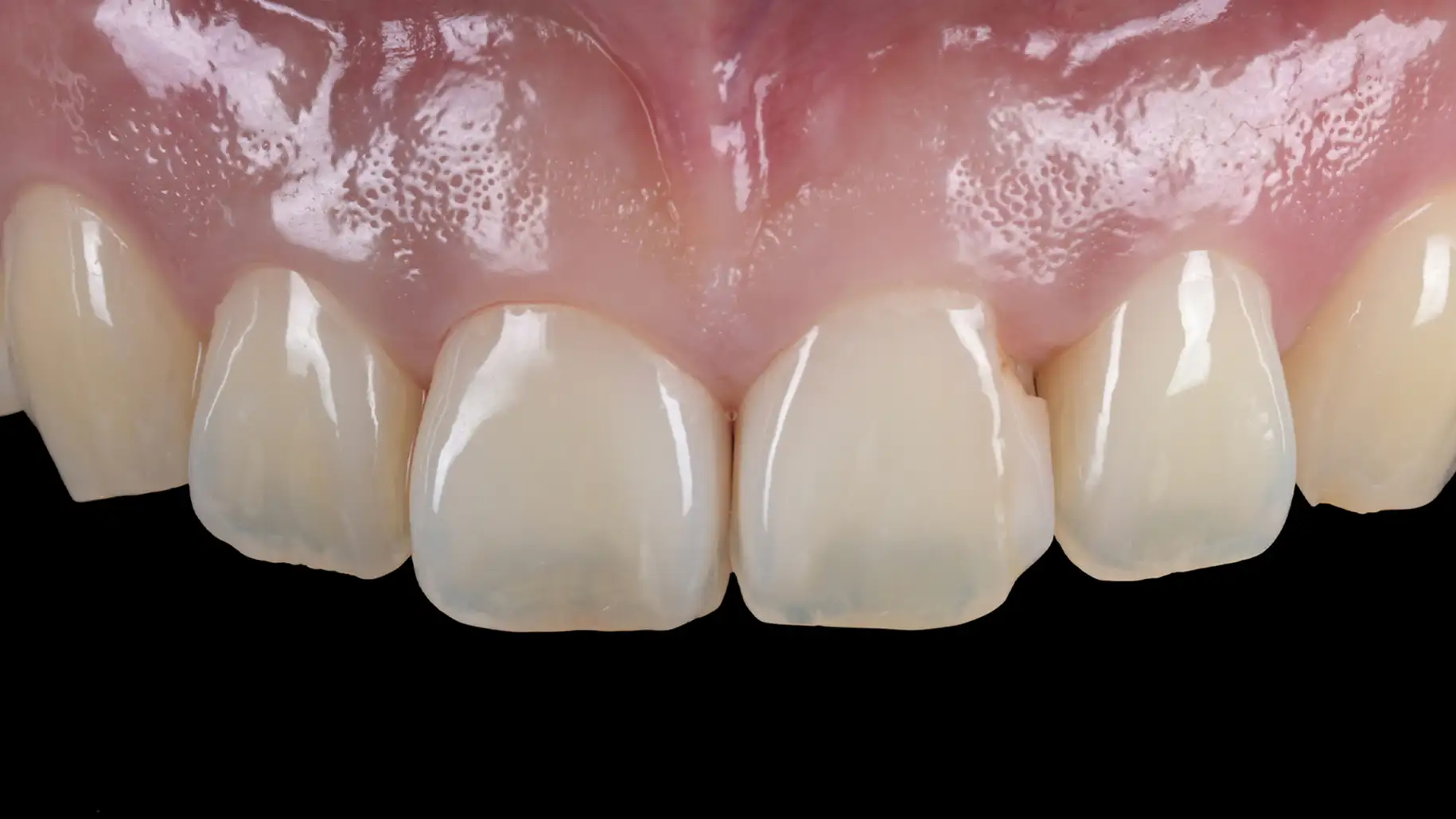 서울심도치과의원 앞니재치료 심미 보철 | 왜소치(선천적 형태 이상)의 무삭제 비니어 재치료 사례