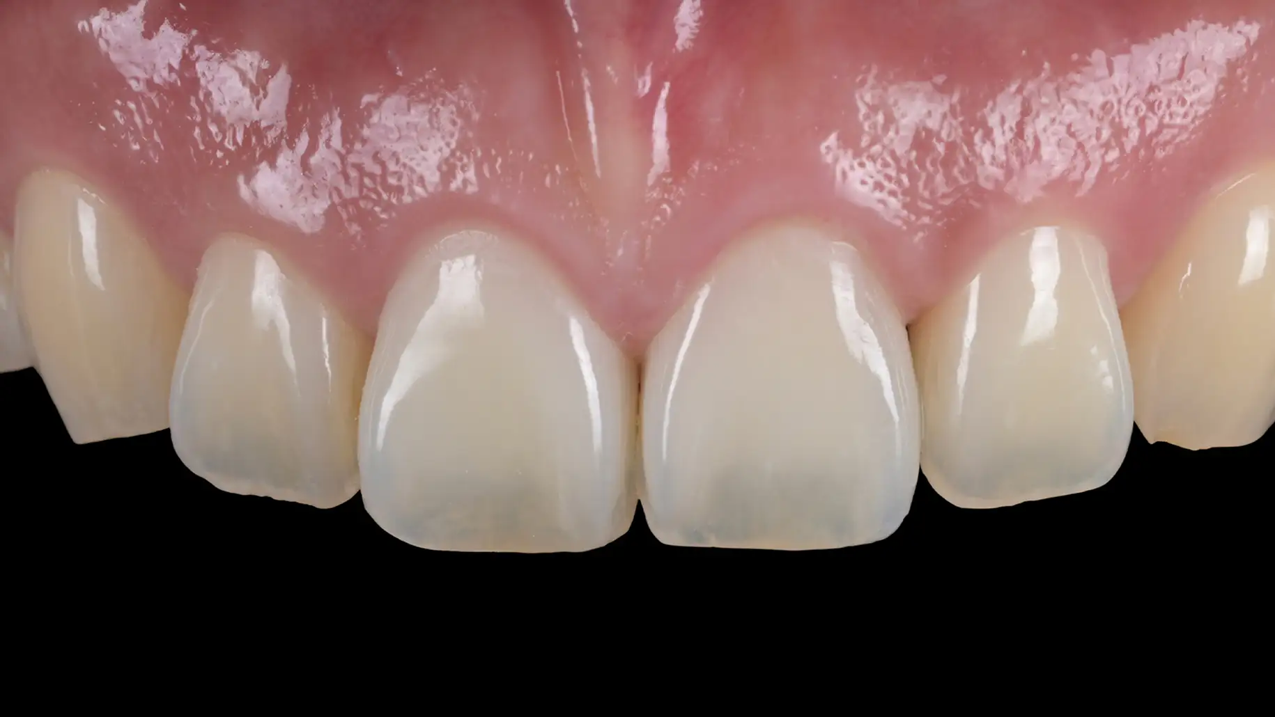 서울심도치과의원 앞니재치료 심미 보철 | 왜소치(선천적 형태 이상)의 무삭제 비니어 재치료 사례