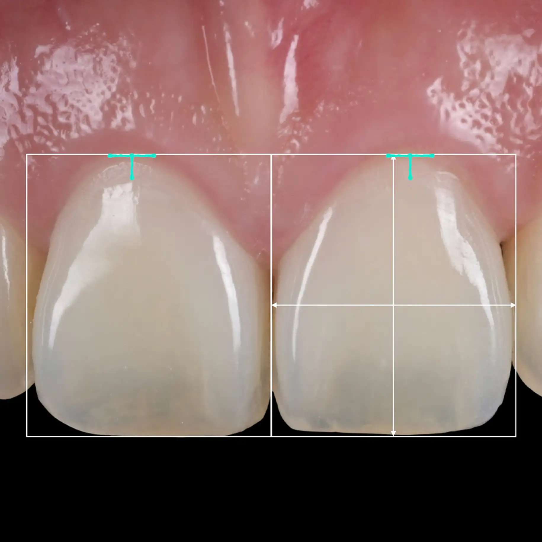 서울심도치과의원 앞니재치료 심미 보철 | 주변 치아와의 조화로운 비율을 계산하고 잇몸 라인의 대칭적 균형을 확보 사례