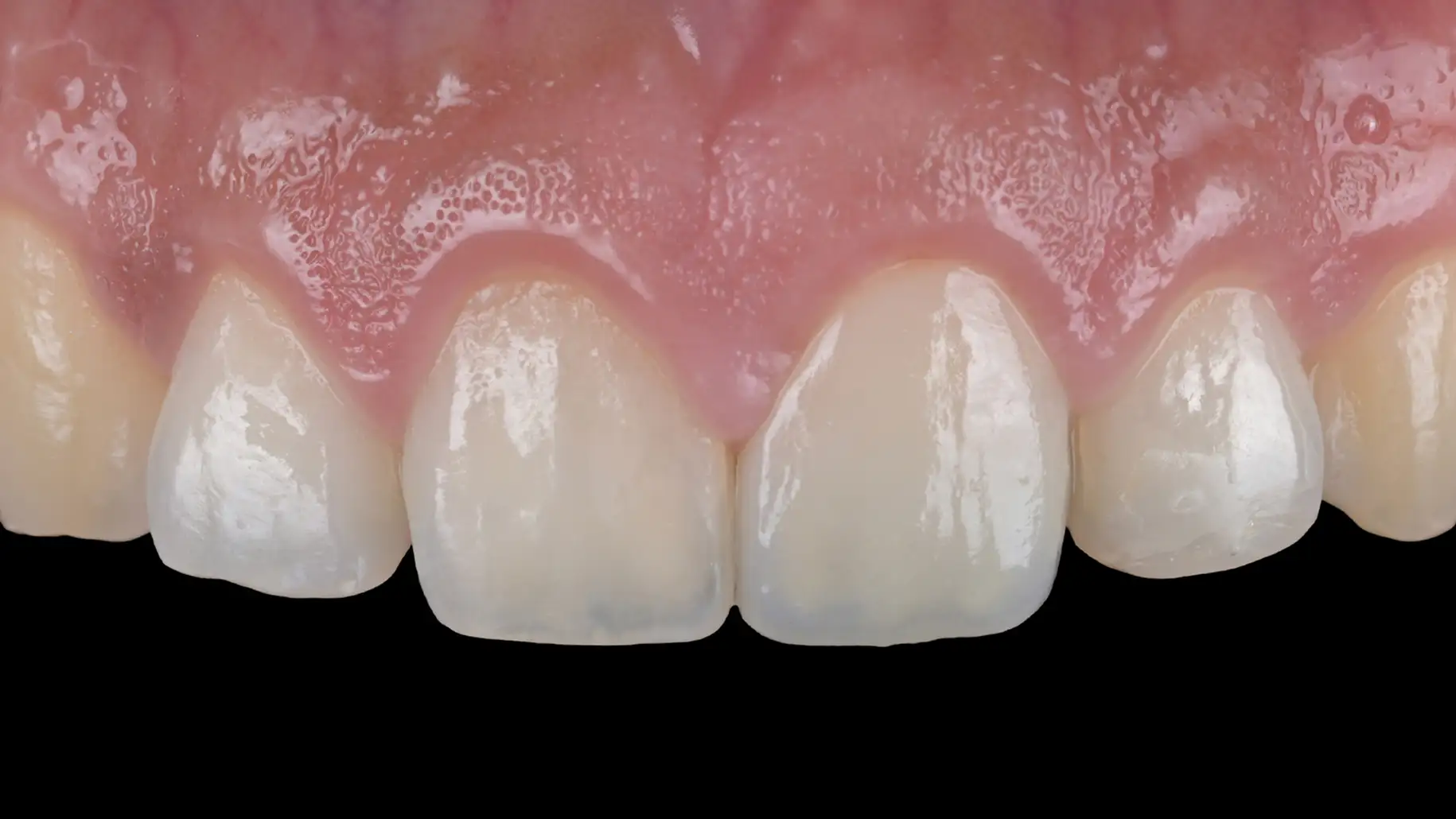 서울심도치과의원 앞니재치료 심미 보철 | 심미 레진 치료와 다층 포세린 빌드업 기법 사례