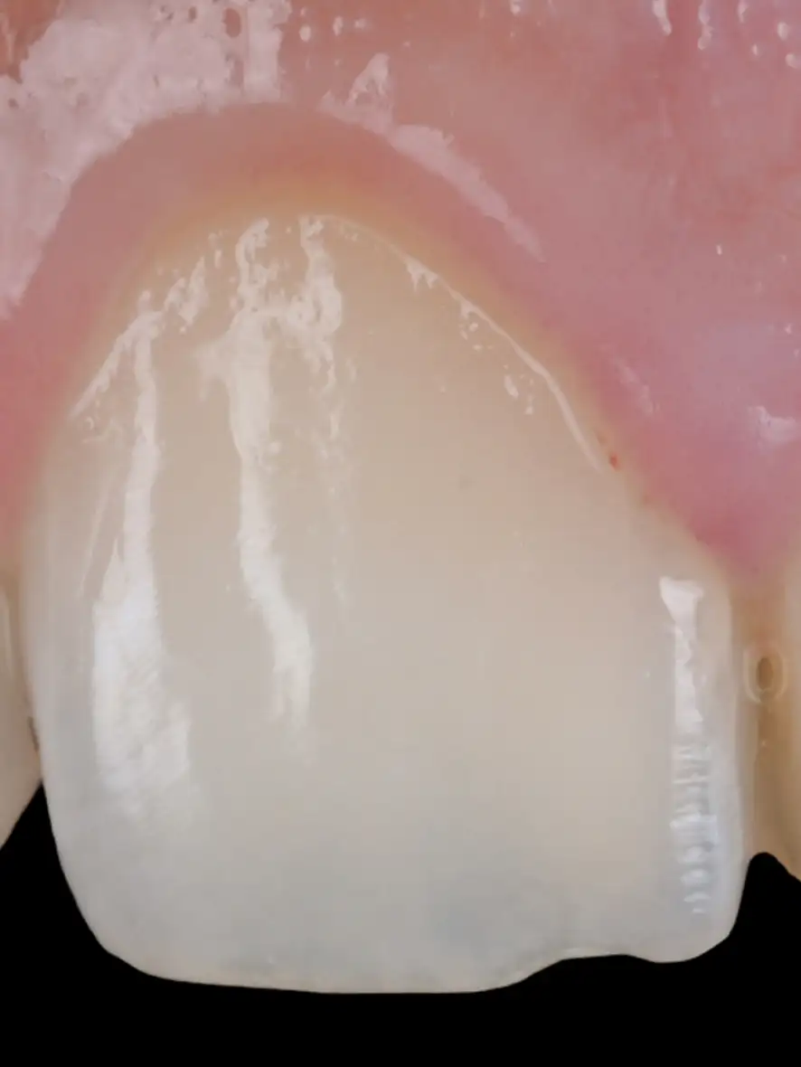 서울심도치과의원 앞니재치료 심미 보철 | 보존적 심미 수복