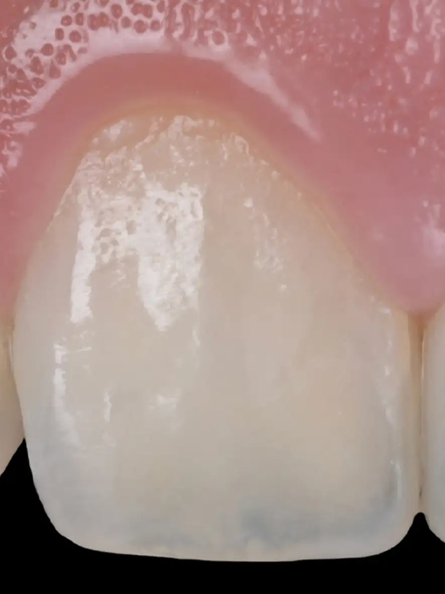 서울심도치과의원 앞니재치료 심미 보철 | 보존적 심미 수복