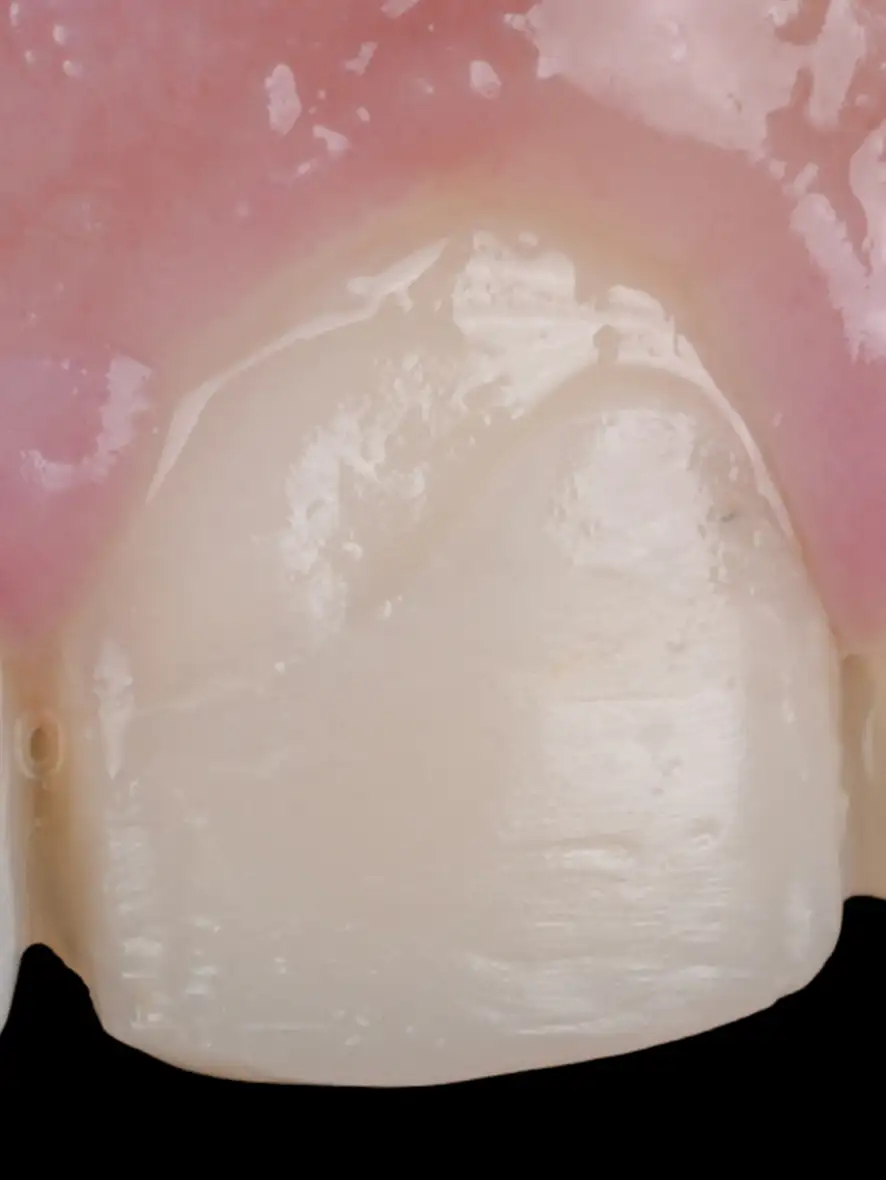 서울심도치과의원 앞니재치료 심미 보철 | 보철적 세라믹 심미 수복