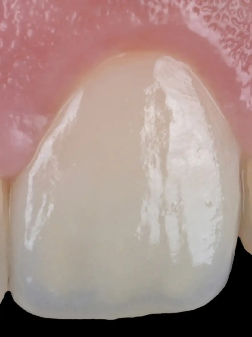 서울심도치과의원 앞니재치료 심미 보철 | 보철적 세라믹 심미 수복