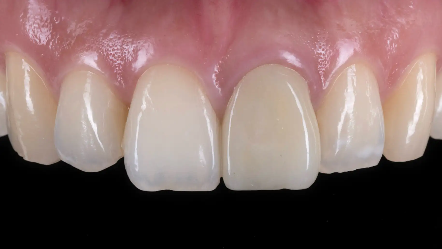 서울심도치과의원 앞니재치료 심미 보철 | 다층 포세린 빌드업 기법을 이용한 전치부 투명도 및 내부 덴틴 구조 재현 사례