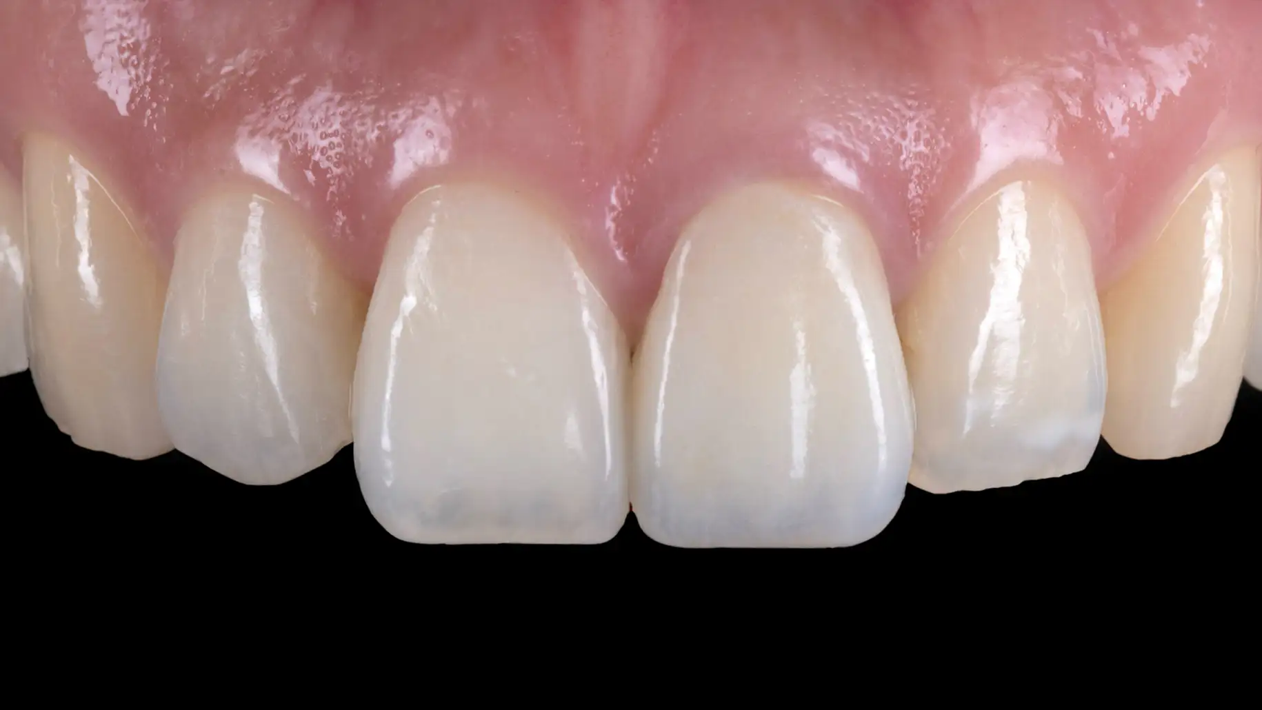 서울심도치과의원 앞니재치료 심미 보철 | 다층 포세린 빌드업 기법을 이용한 전치부 투명도 및 내부 덴틴 구조 재현 사례