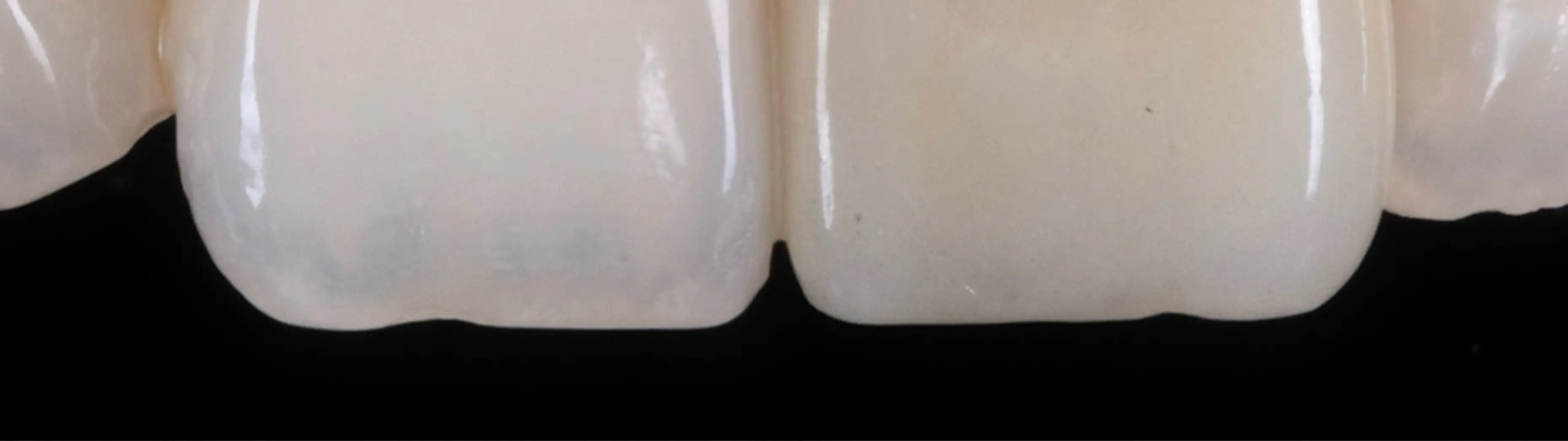 서울심도치과의원 앞니재치료 심미 보철 | 다층 포세린 빌드업 기법을 이용한 전치부 투명도 및 내부 덴틴 구조 재현 사례