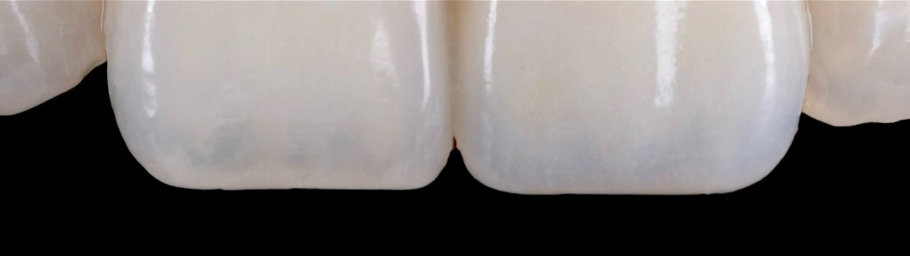 서울심도치과의원 앞니재치료 심미 보철 | 다층 포세린 빌드업 기법을 이용한 전치부 투명도 및 내부 덴틴 구조 재현 사례