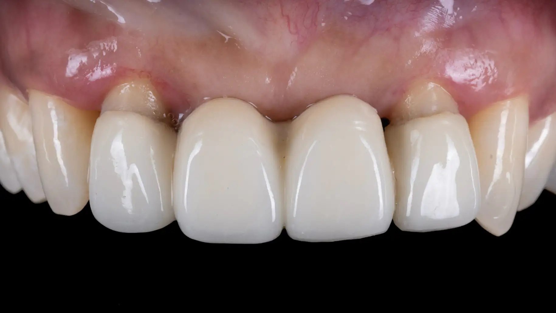 서울심도치과의원 앞니재치료 심미 보철 | 치아 심미(White Esthetic), 연조직 심미(Pink Esthetic) 병행 사례