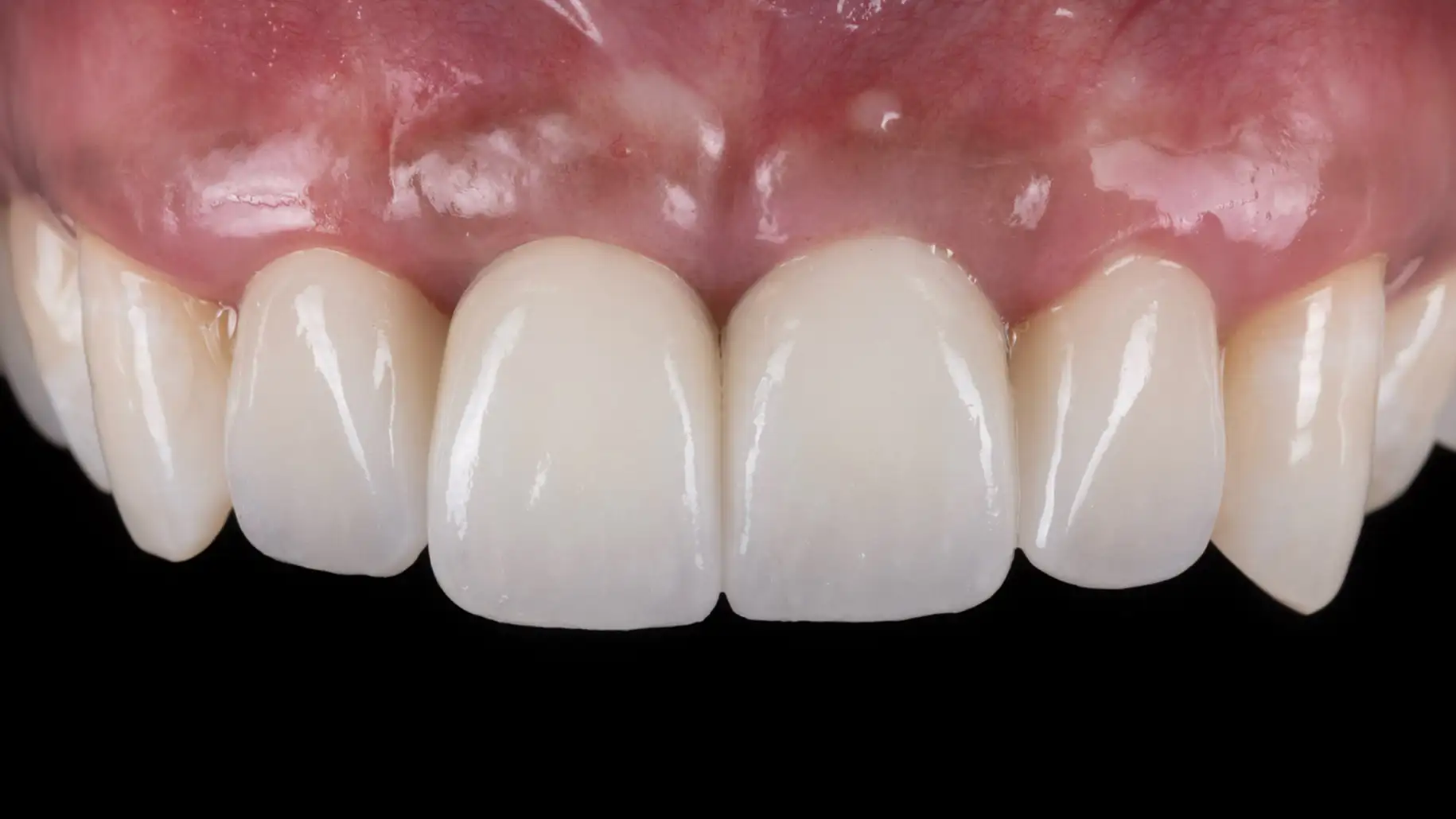 서울심도치과의원 앞니재치료 심미 보철 | 치아 심미(White Esthetic), 연조직 심미(Pink Esthetic) 병행 사례