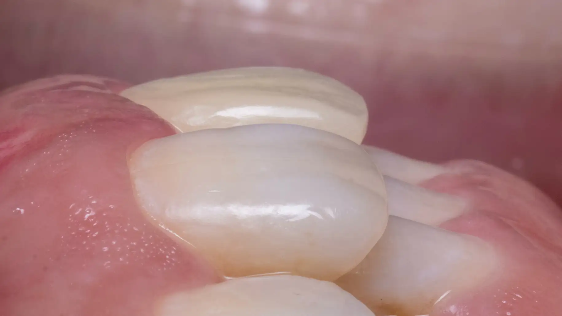 서울심도치과의원 앞니재치료 심미 보철 | 임시치아는 최종 보철물의 완성도를 결정하는 정밀한 진단 과정