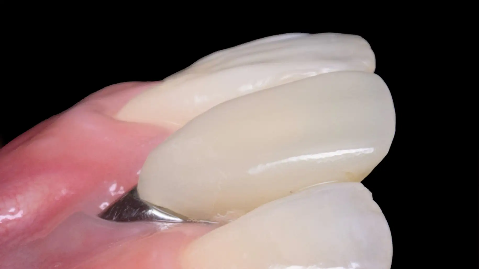 서울심도치과의원 앞니재치료 앞니임플란트 | 정밀한 진단과 치료를 통해, 부족한 잇몸의 두께와 높이를 회복하여 치료한 사례