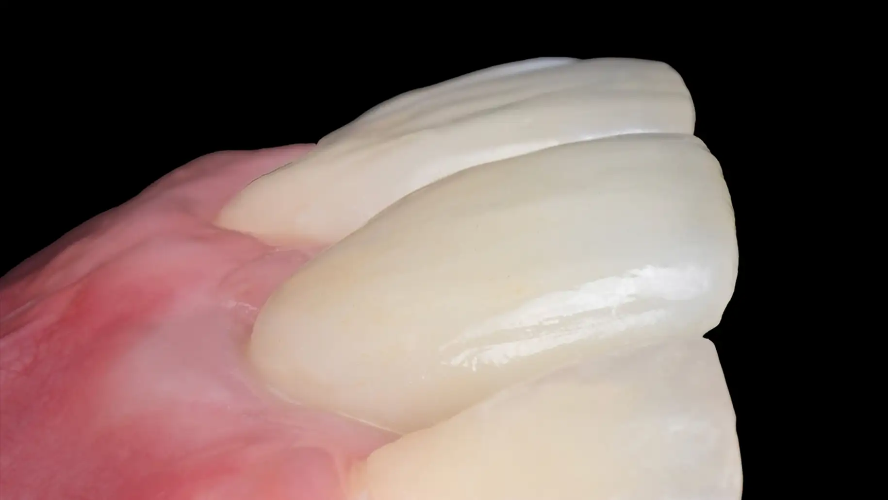 서울심도치과의원 앞니재치료 앞니임플란트 | 정밀한 진단과 치료를 통해, 부족한 잇몸의 두께와 높이를 회복하여 치료한 사례