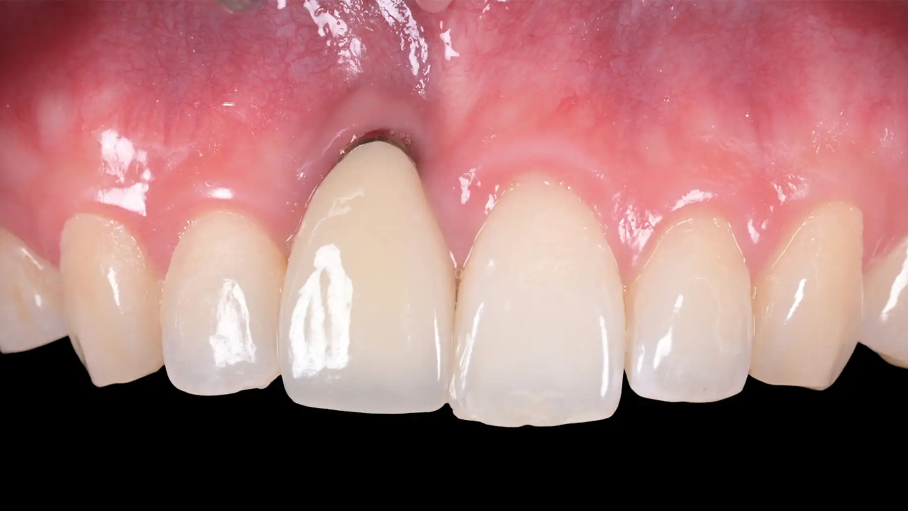 서울심도치과의원 앞니재치료 앞니임플란트 | 잇몸의 퇴축은 심미적인 실패를 넘어 임플란트 주위염과 나아가 임플란트의 장기적인 안정성에 영향