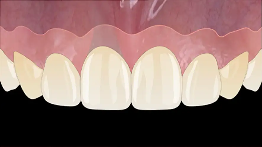 서울심도치과의원 앞니재치료 앞니임플란트 | 잇몸 퇴축 정도, 주변 조직 상태, 기존 임플란트 3차원적 식립 위치 및 각도, 인접치 조화 평가 후 적합 재치료 방향수립 Class Ⅰ