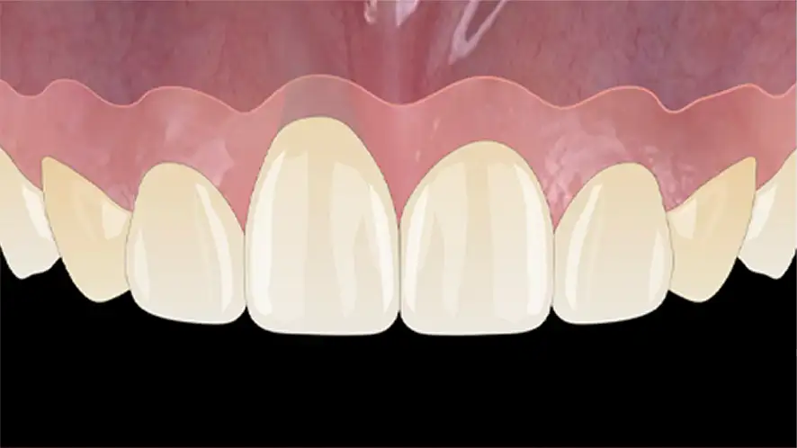 서울심도치과의원 앞니재치료 앞니임플란트 | 잇몸 퇴축 정도, 주변 조직 상태, 기존 임플란트 3차원적 식립 위치 및 각도, 인접치 조화 평가 후 적합 재치료 방향수립 Class Ⅱ