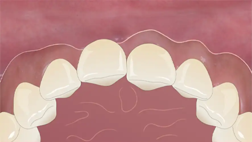 서울심도치과의원 앞니재치료 앞니임플란트 | 잇몸 퇴축 정도, 주변 조직 상태, 기존 임플란트 3차원적 식립 위치 및 각도, 인접치 조화 평가 후 적합 재치료 방향수립 Class Ⅱ