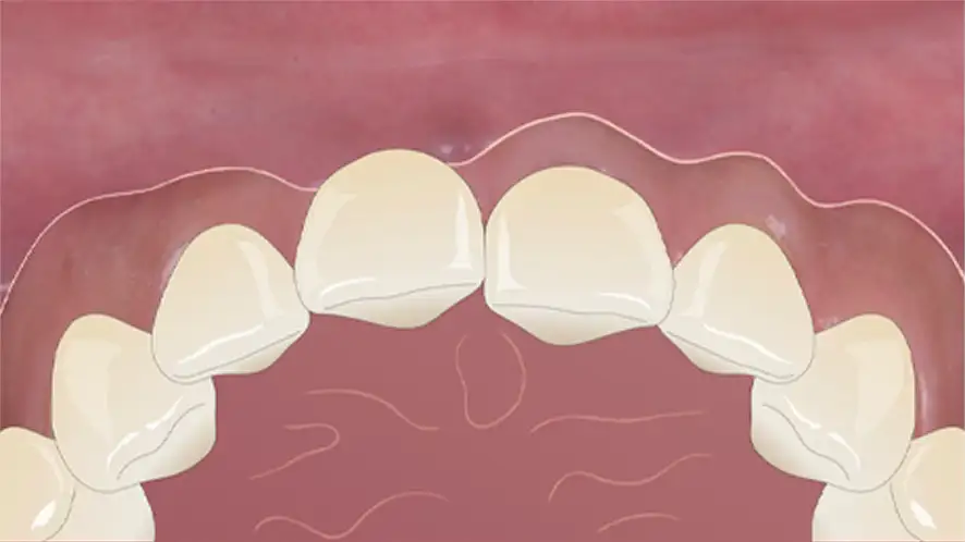 서울심도치과의원 앞니재치료 앞니임플란트 | 잇몸 퇴축 정도, 주변 조직 상태, 기존 임플란트 3차원적 식립 위치 및 각도, 인접치 조화 평가 후 적합 재치료 방향수립 Class Ⅲ