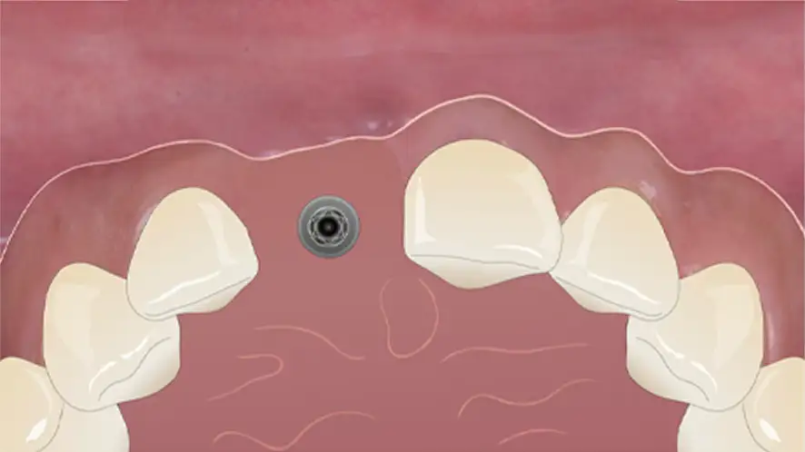 서울심도치과의원 앞니재치료 앞니임플란트 | 잇몸 퇴축 정도, 주변 조직 상태, 기존 임플란트 3차원적 식립 위치 및 각도, 인접치 조화 평가 후 적합 재치료 방향수립 Class Ⅳ