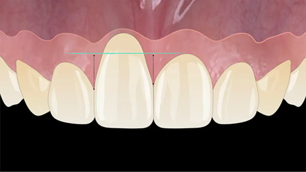 서울심도치과의원 앞니재치료 앞니임플란트 | 잇몸 퇴축 정도, 주변 조직 상태, 기존 임플란트 3차원적 식립 위치 및 각도, 인접치 조화 평가 후 적합 재치료 방향수립 Subclass A