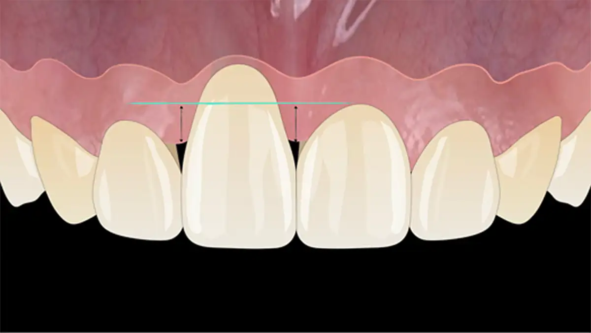 서울심도치과의원 앞니재치료 앞니임플란트 | 잇몸 퇴축 정도, 주변 조직 상태, 기존 임플란트 3차원적 식립 위치 및 각도, 인접치 조화 평가 후 적합 재치료 방향수립 Subclass B