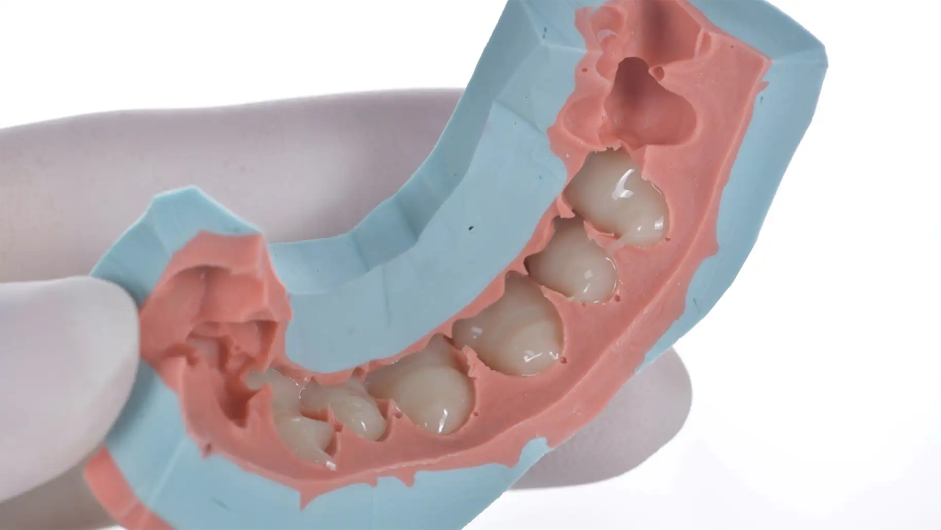 서울심도치과의원 앞니재치료 라미네이트 | 목업 (Mock-up) 치아 보존을 위한 가장 확실한 설계도