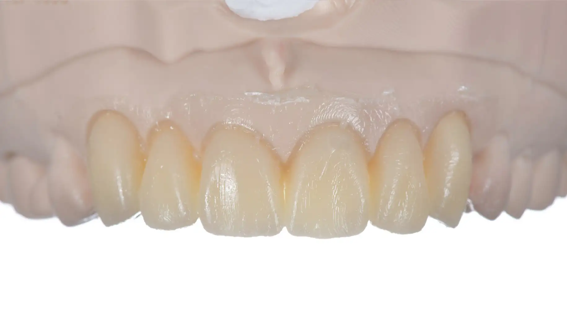 서울심도치과의원 앞니재치료 라미네이트 | 목업 (Mock-up) 치아 보존을 위한 가장 확실한 설계도