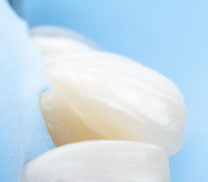 서울심도치과의원 | 앞니재치료 라미네이트