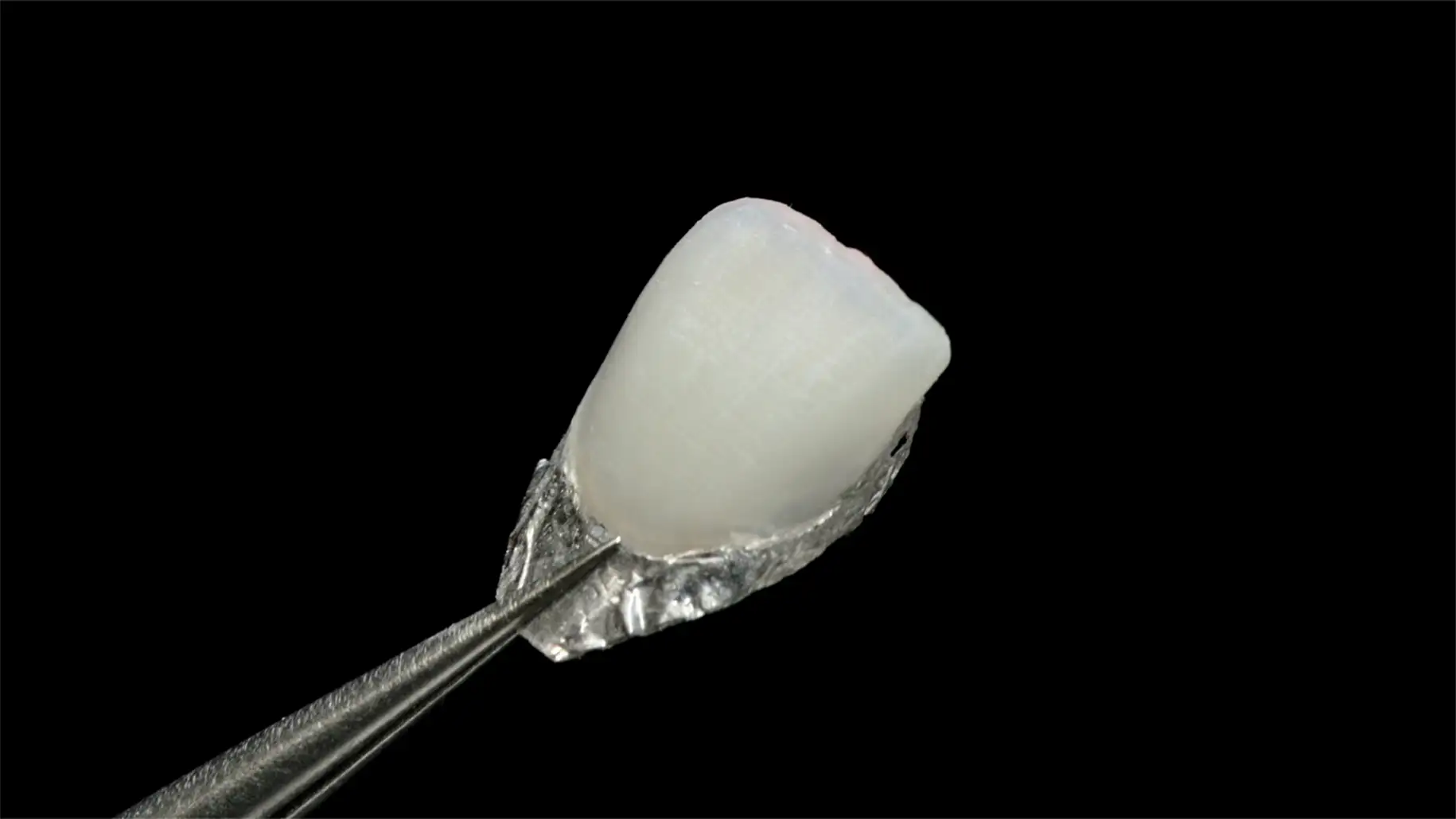 서울심도치과의원 앞니재치료 라미네이트 | 백금박 라미네이트 비니어