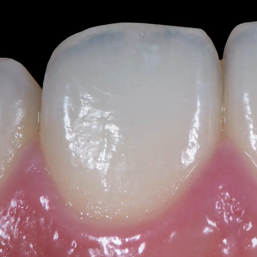 서울심도치과의원 앞니재치료 심미 보철 | 보존적 심미 수복