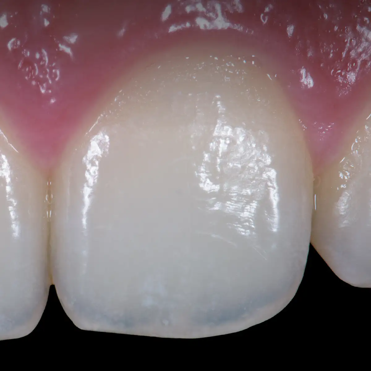 서울심도치과의원 앞니재치료 라미네이트 | 자연치