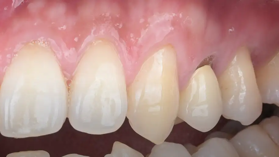 서울심도치과의원 잇몸 재생술 필요 이유 | 자연스러운 미소의 회복 사례