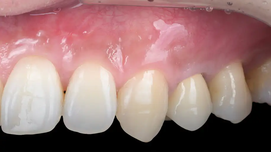 서울심도치과의원 잇몸 재생술 필요 이유 | 자연스러운 미소의 회복 사례