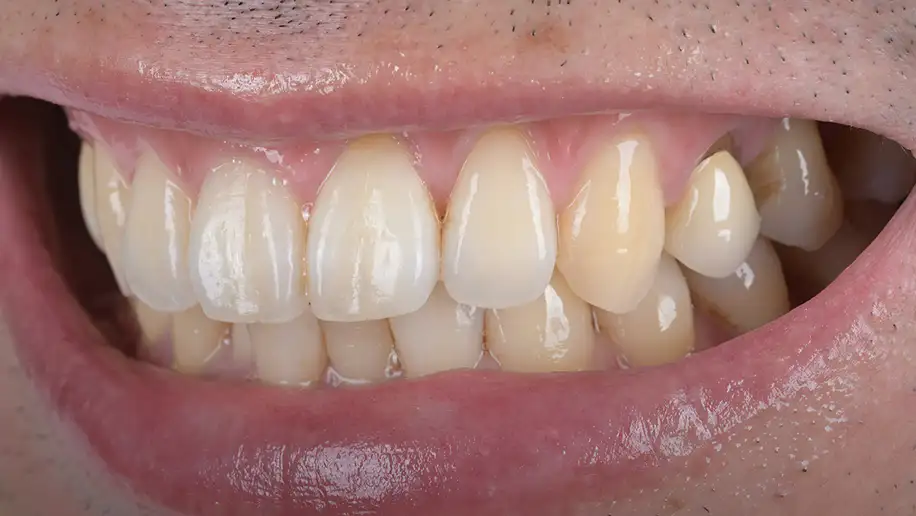 서울심도치과의원 잇몸 재생술 필요 이유 | 치아 시림 해결과 충치 예방