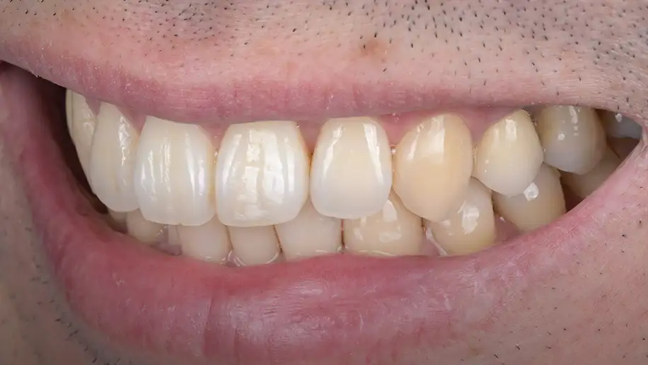 서울심도치과의원 잇몸 재생술 필요 이유 | 치아 시림 해결과 충치 예방