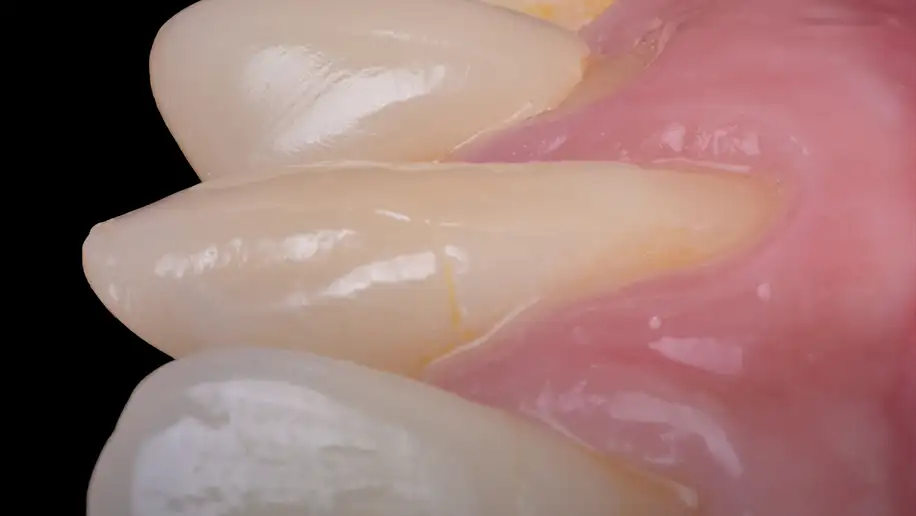 서울심도치과의원 잇몸 재생술 필요 이유 | 치아 시림 해결과 충치 예방