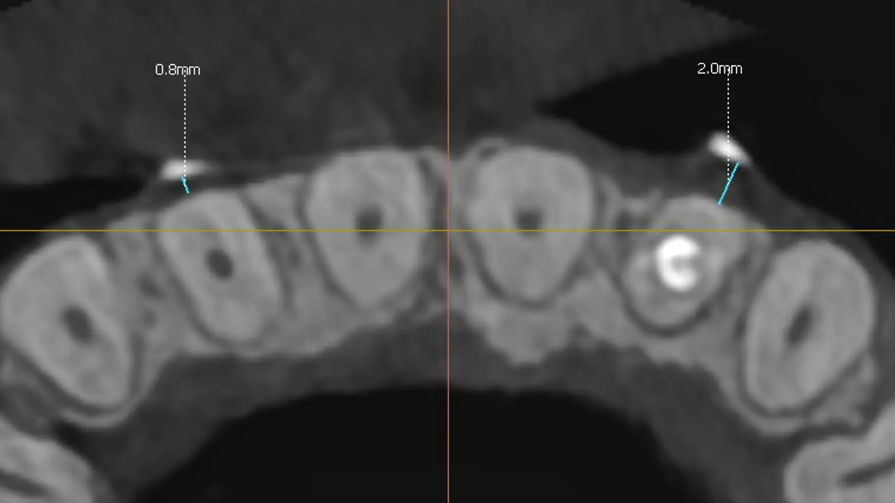 서울심도치과의원 잇몸 재생술 필요 이유 | 추가적인 잇몸 퇴축 방지
