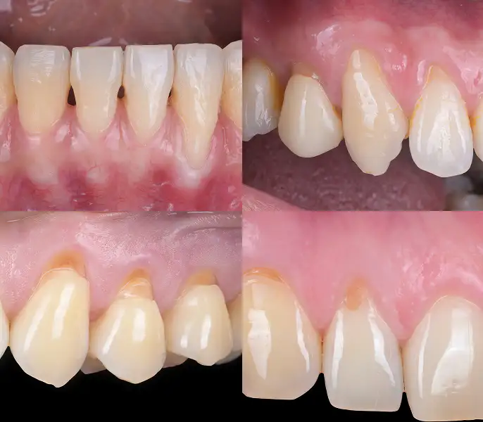 서울심도치과의원 | 잇몸 재생 치료