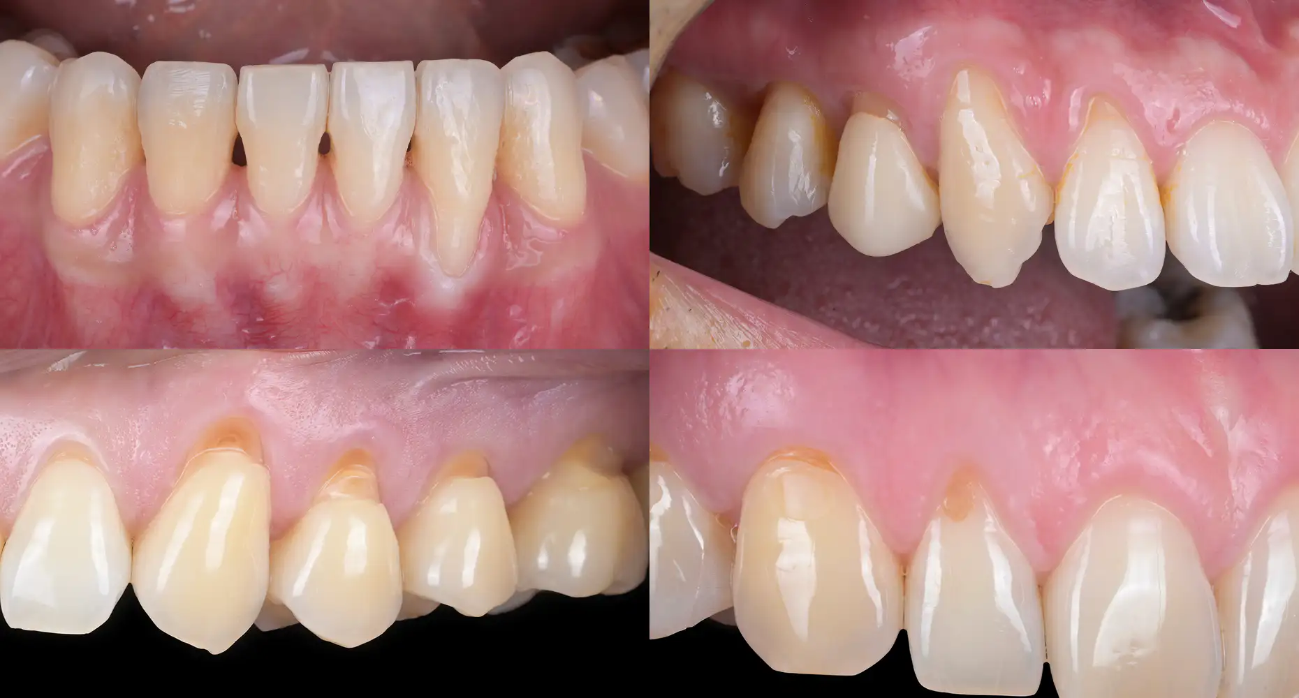 서울심도치과의원 | 잇몸 재생 치료