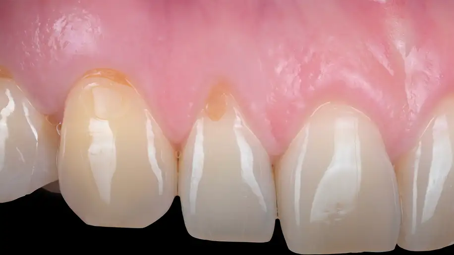 서울심도치과의원 잇몸 재생 치료 | 퇴축된 위 앞니 잇몸의 재생 치료 증례