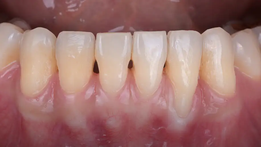 서울심도치과의원 잇몸 재생 치료 | 퇴축된 아래 앞니의 잇몸 재생 치료 증례