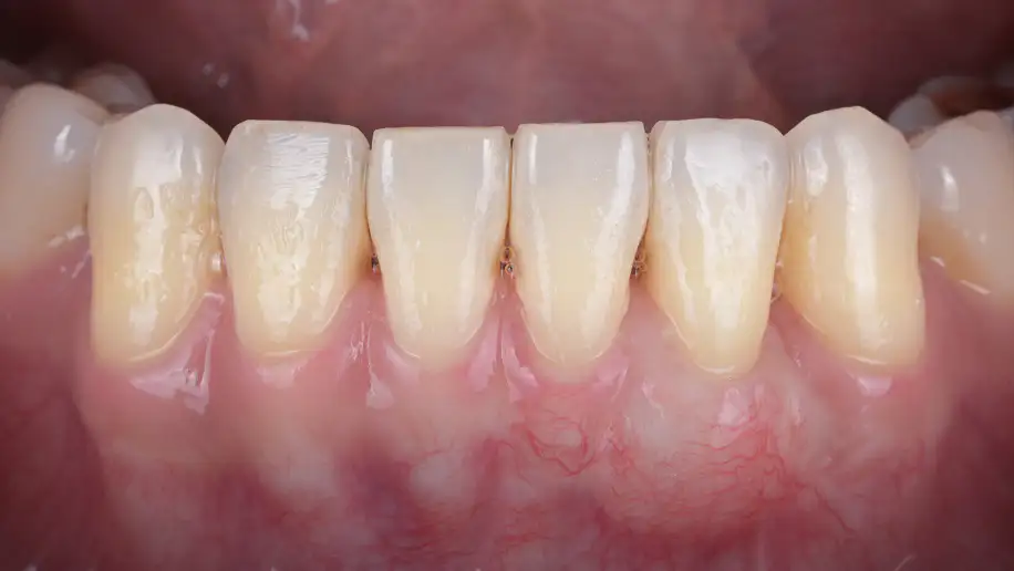 서울심도치과의원 잇몸 재생 치료 | 퇴축된 아래 앞니의 잇몸 재생 치료 증례